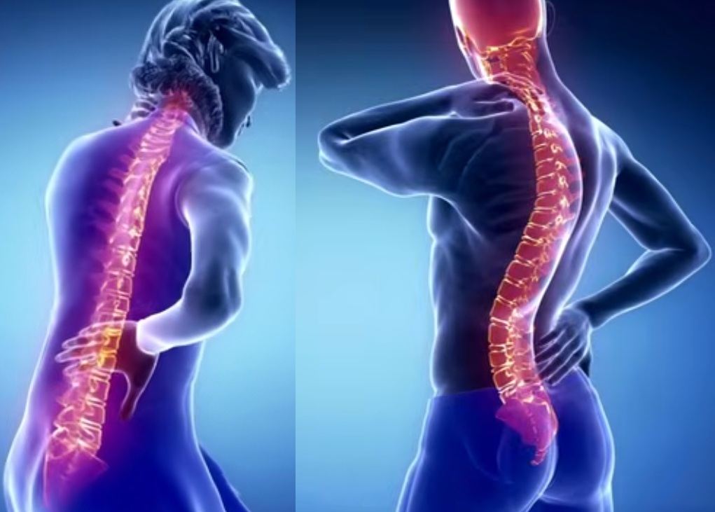 Central Neuropathic Pain