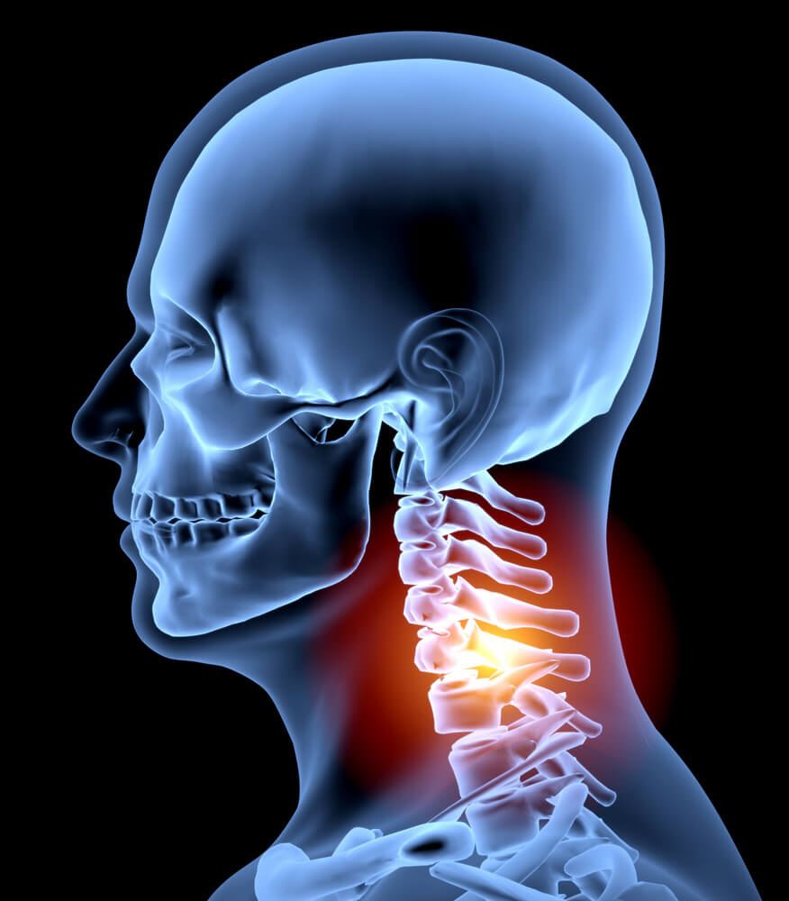 Chronic Neck Pain