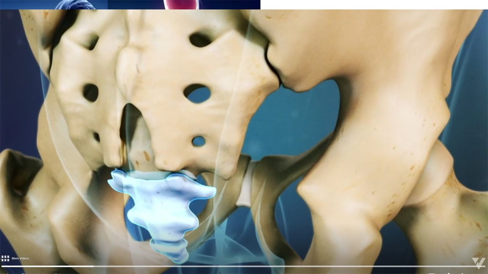 Coccygeal Pain (Coccydynia)