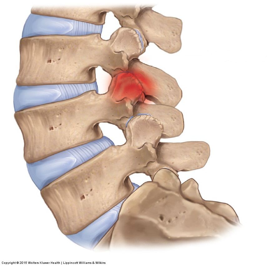 Facet-Mediated Spinal Pain