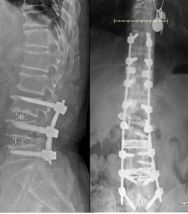 Persistent Spinal Pain Syndrome (Failed Back Surgery Syndrome)