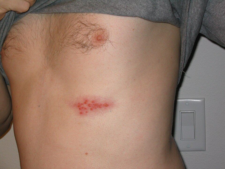 Post-Herpetic Neuralgia