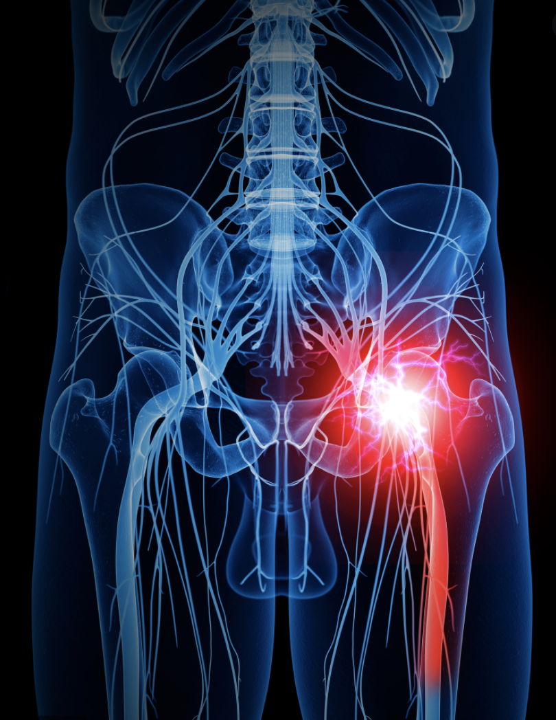 Sciatica and Lumbar Radicular Pain