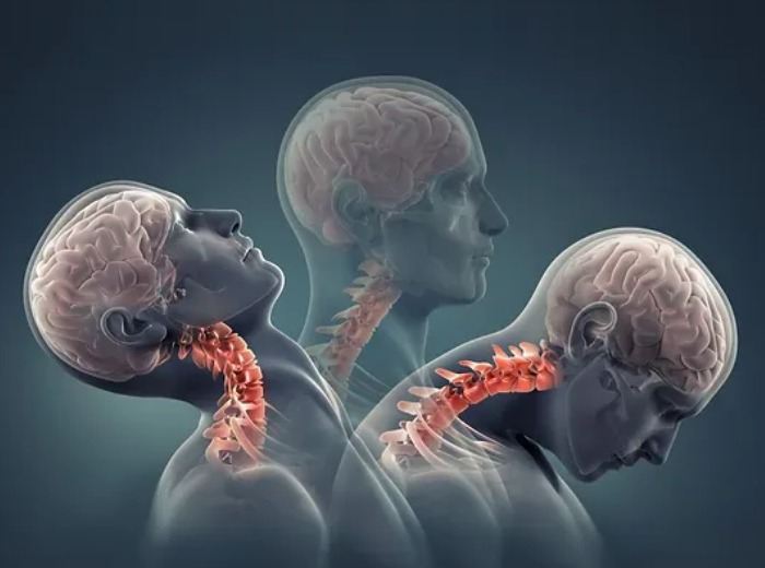 Whiplash-Associated Disorder