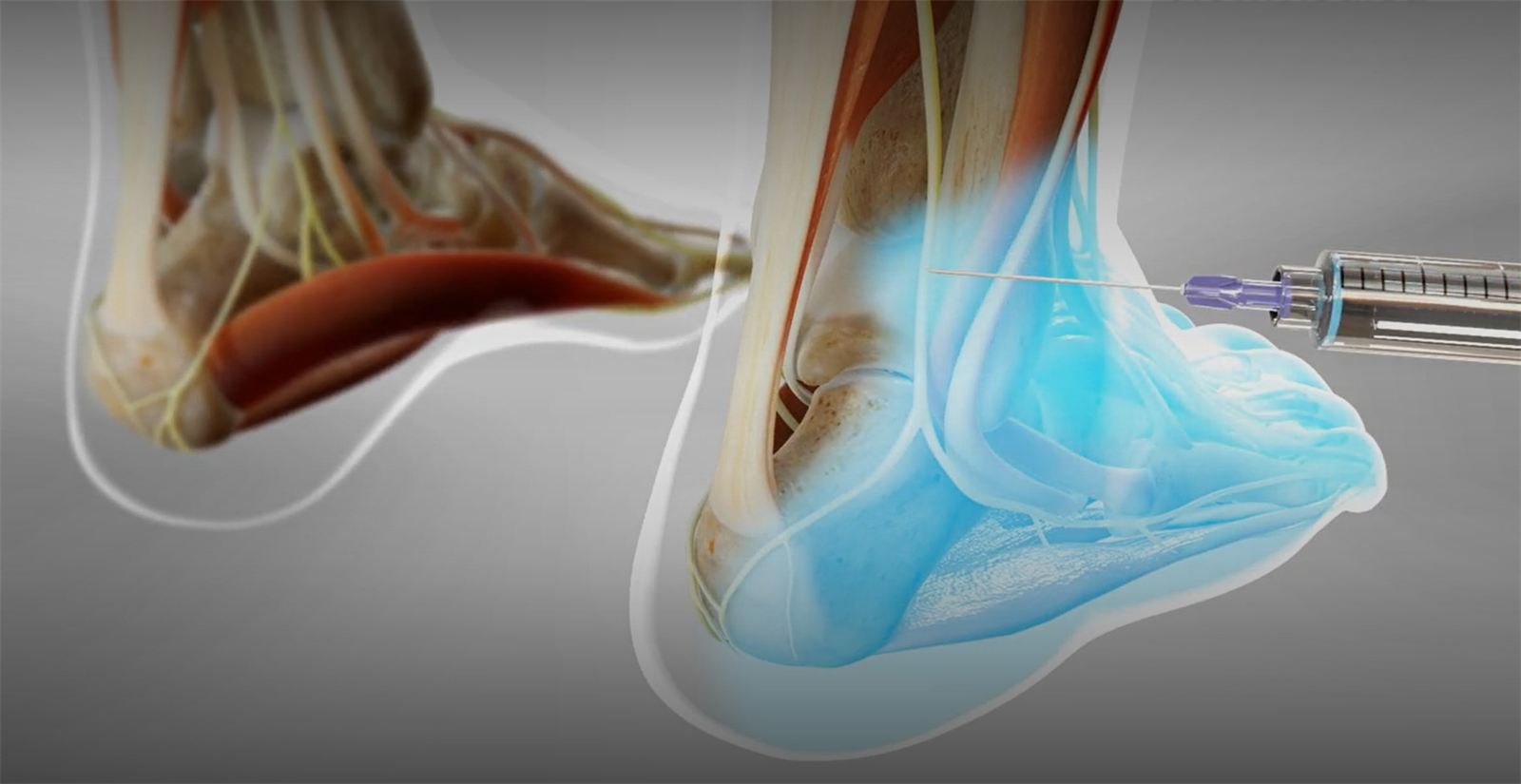Ankle Nerves Block
