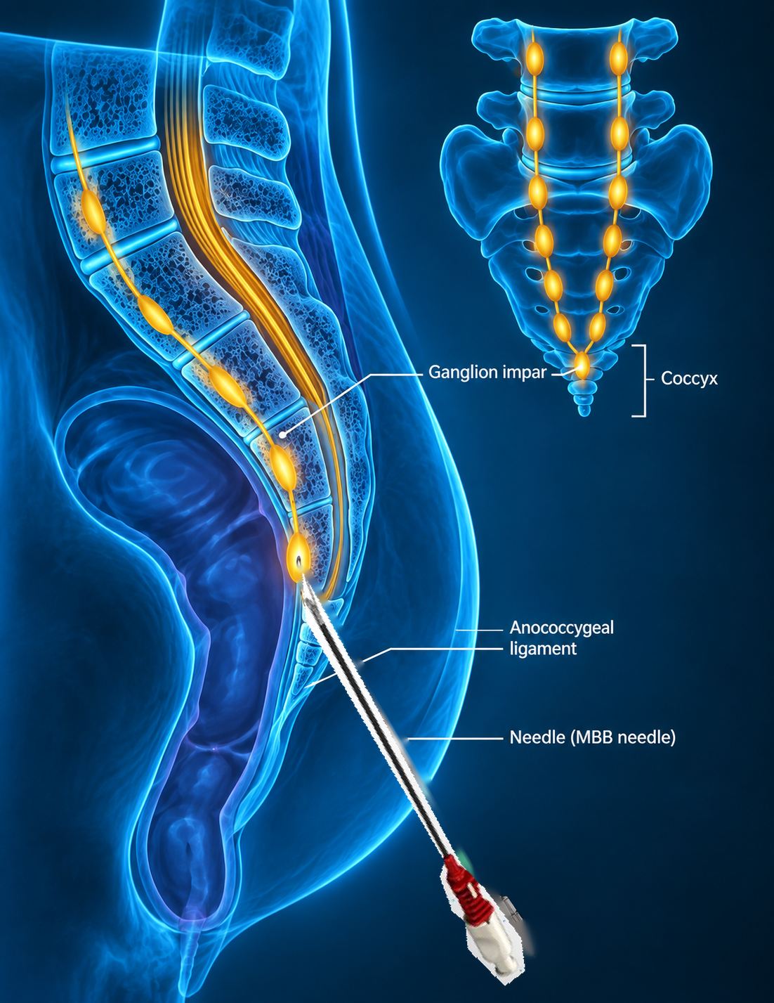 Ganglion Impar Radiofrequency therapy
