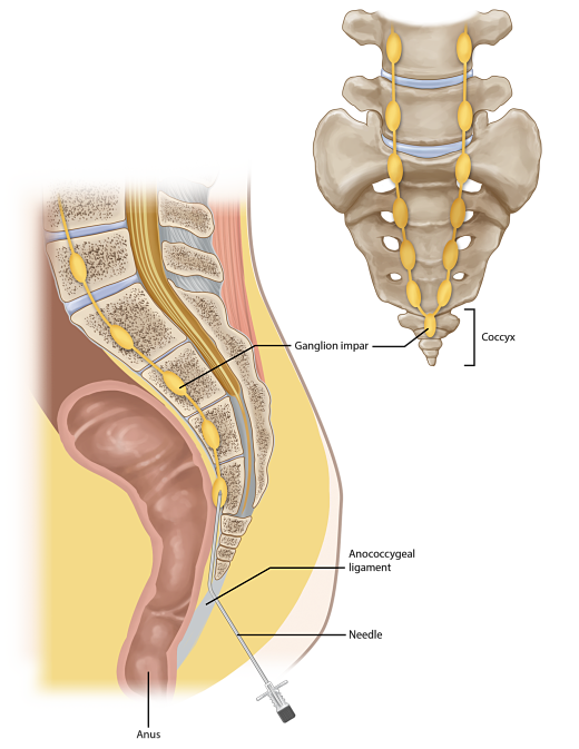 Ganglion Impar Block