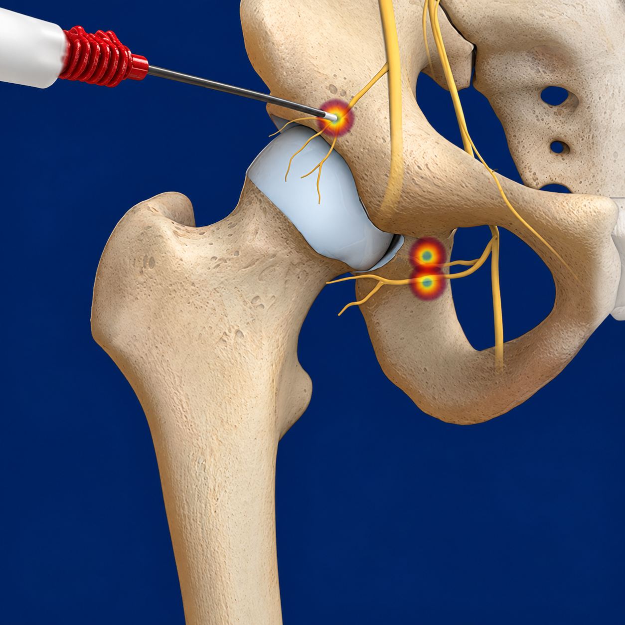 Hip Joint Denervation/Neurotomy