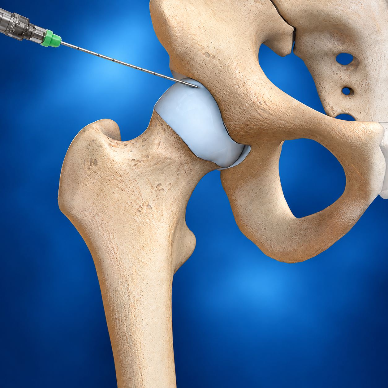 Hip Joint Intra-Articular Injection