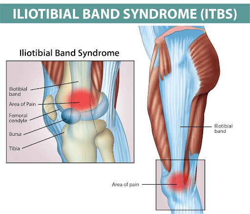 Iliotibial Band Injection