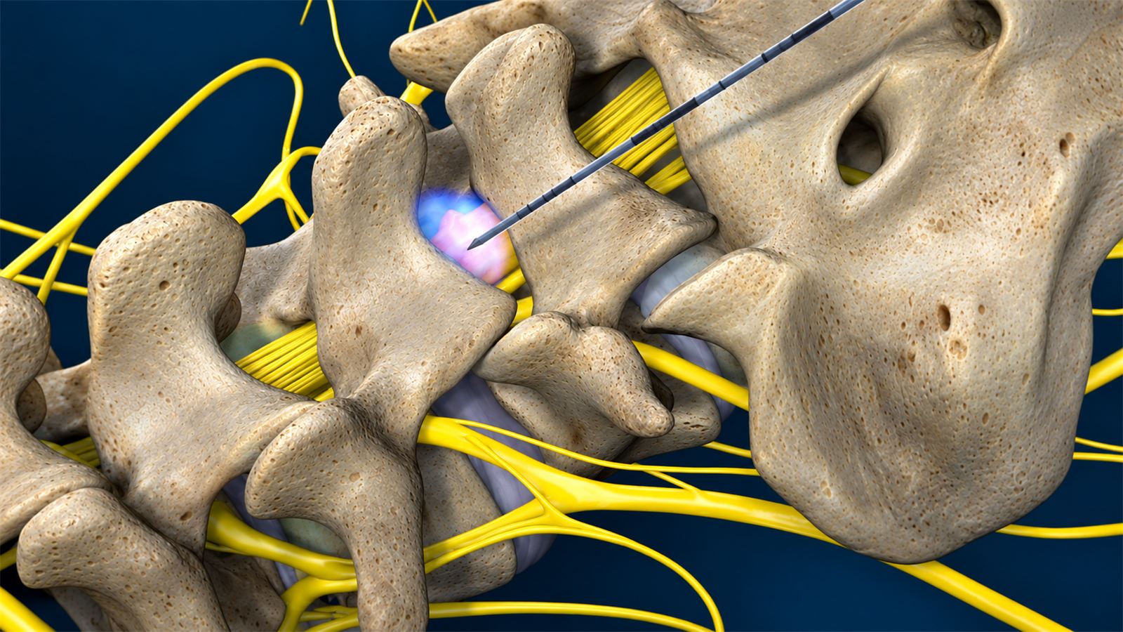 LESI (Lumbar Epidural Steroid Injection)