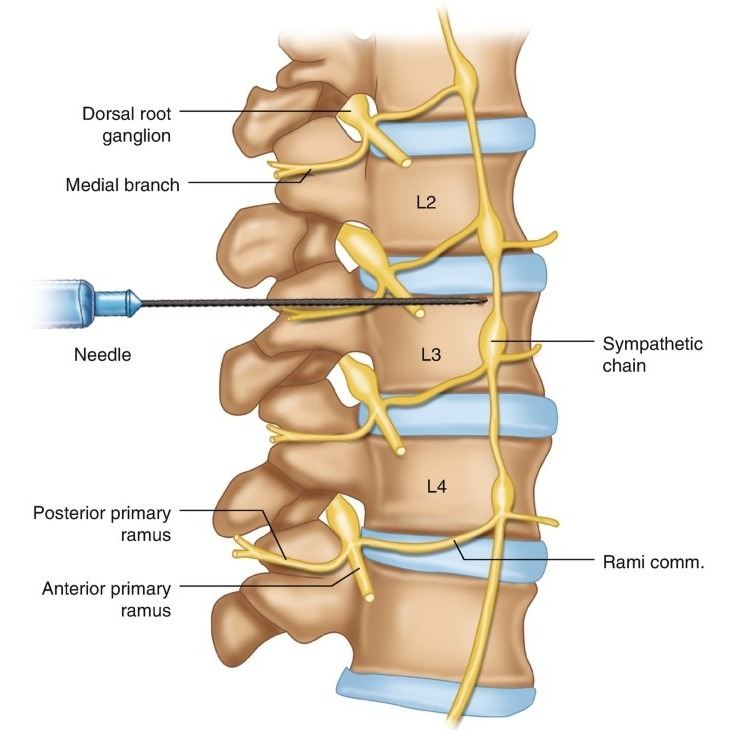 Lumbar Sympathetic Block