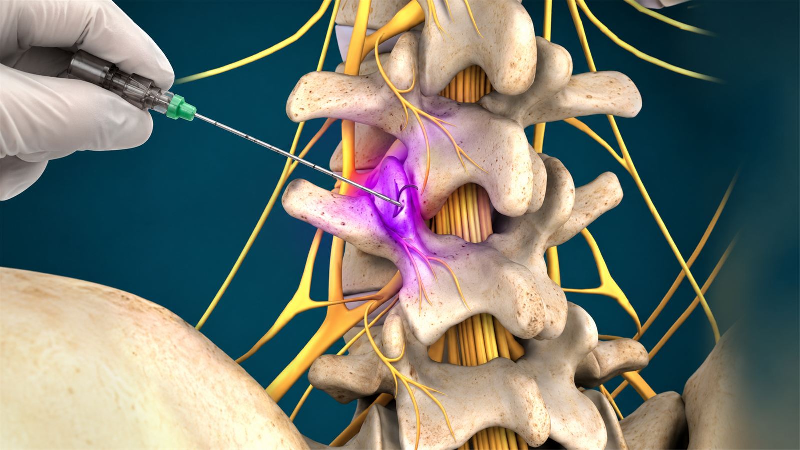 Medial Branch Block