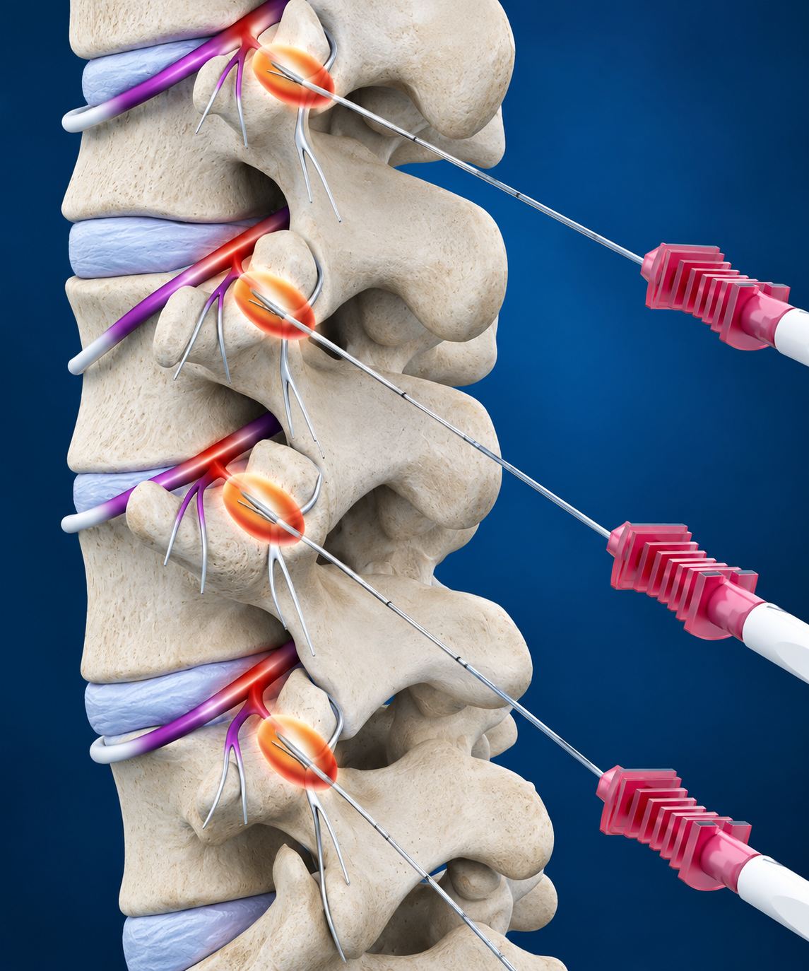 Medial Branch Pulsed Radiofrequency Therapy and Block