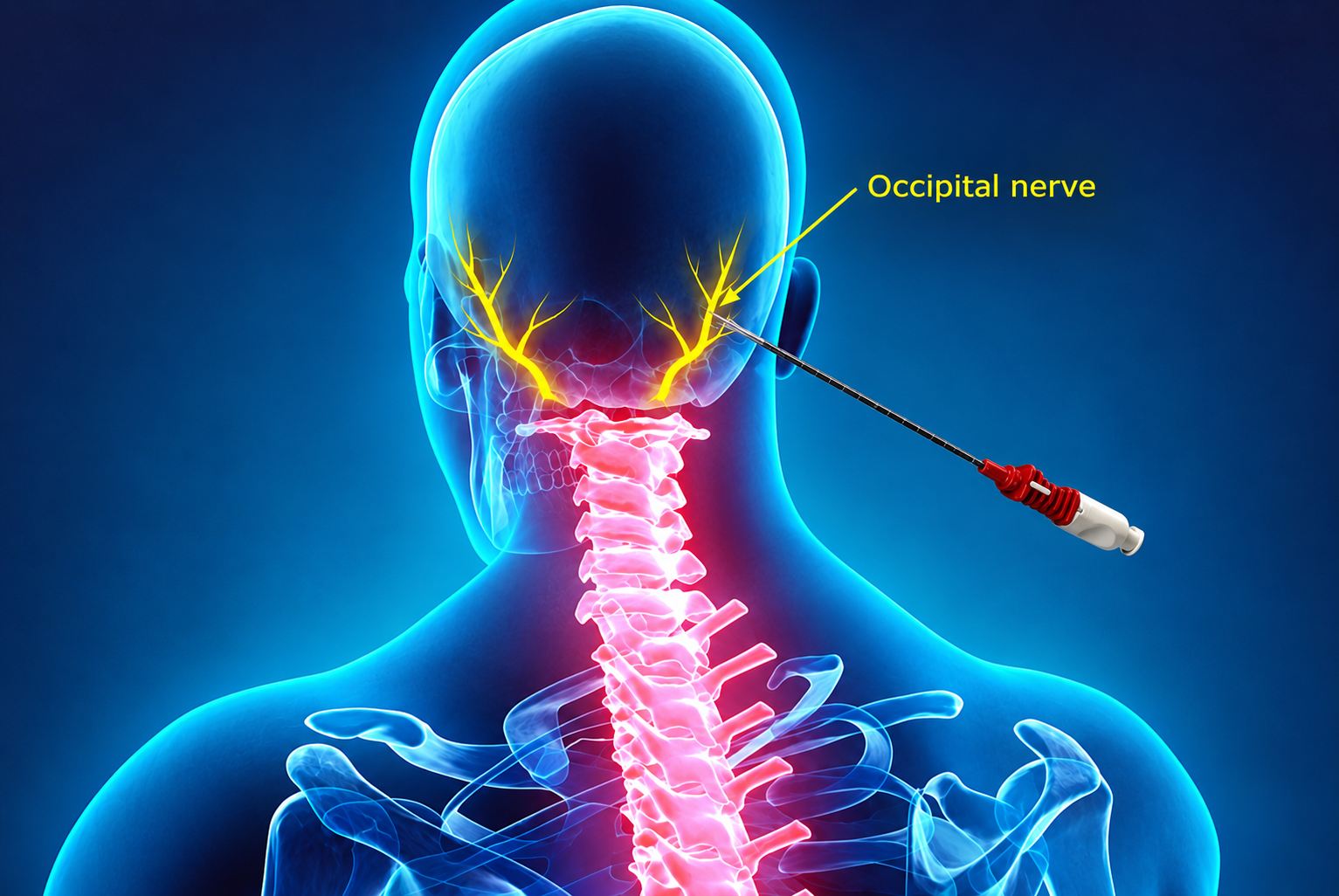 Occipital Nerves Pulsed Radiofrequency and Block