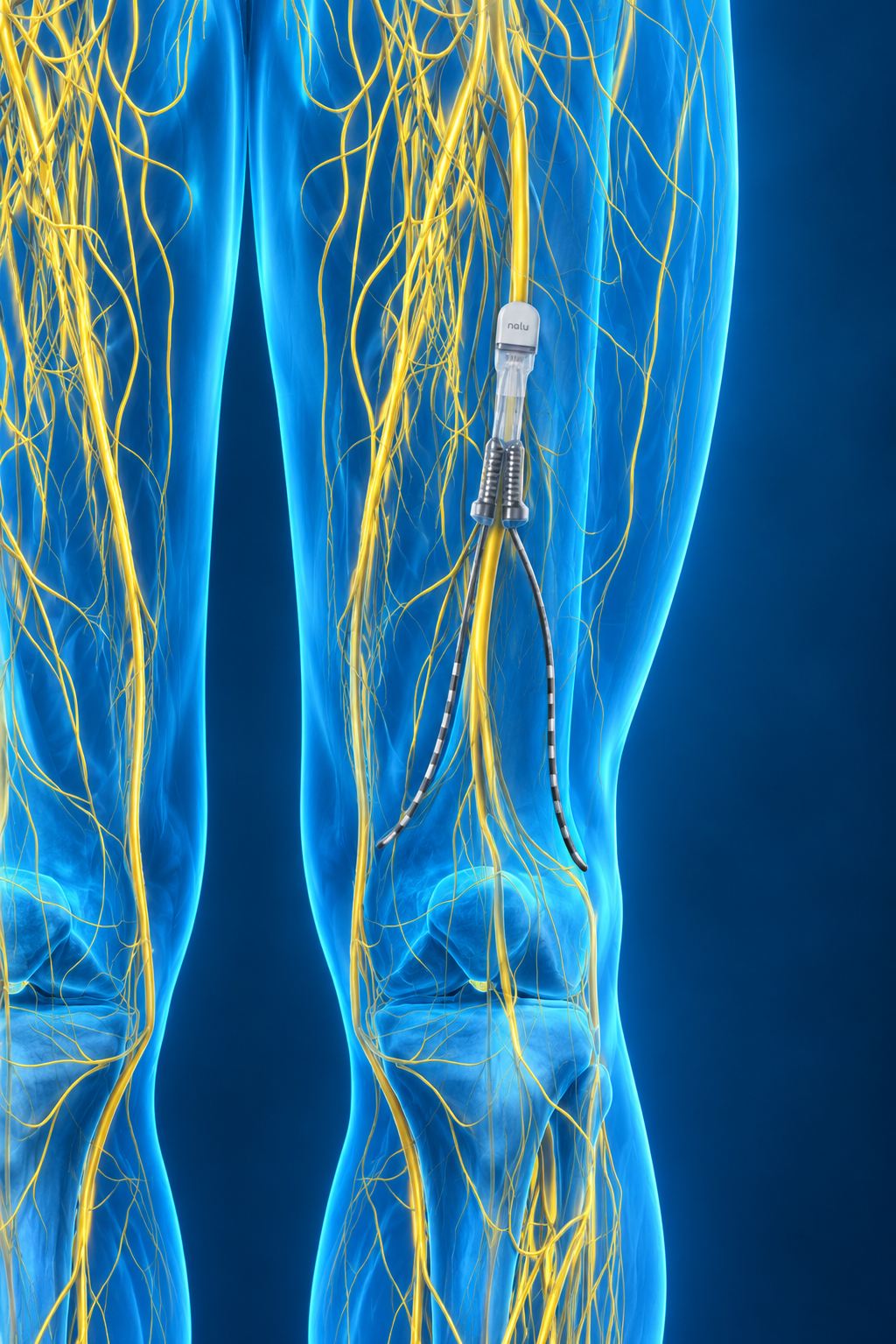 Peripheral Nerve Stimulation Implant