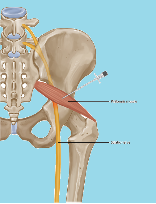 Piriformis Muscle Injection