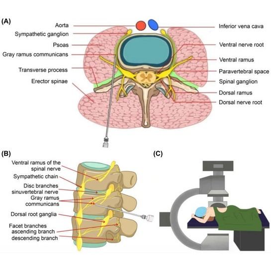 Rami Communicans Pulsed Radiofrequency and Block
