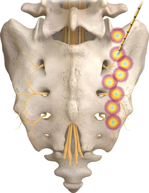 Sacroiliac (SI) Joint Radiofrequency Neurotomy