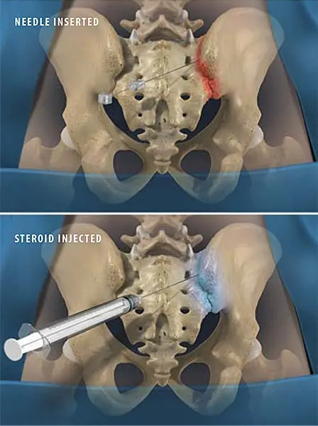 Sacroiliac (SI) Joint injection