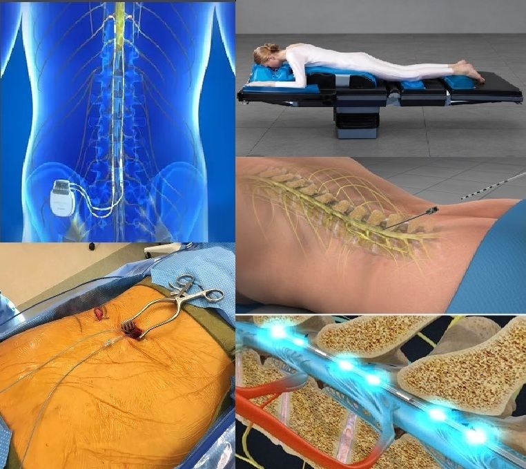 Spinal Cord Stimulator Implant