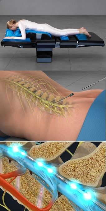 Spinal Cord Stimulator Trial