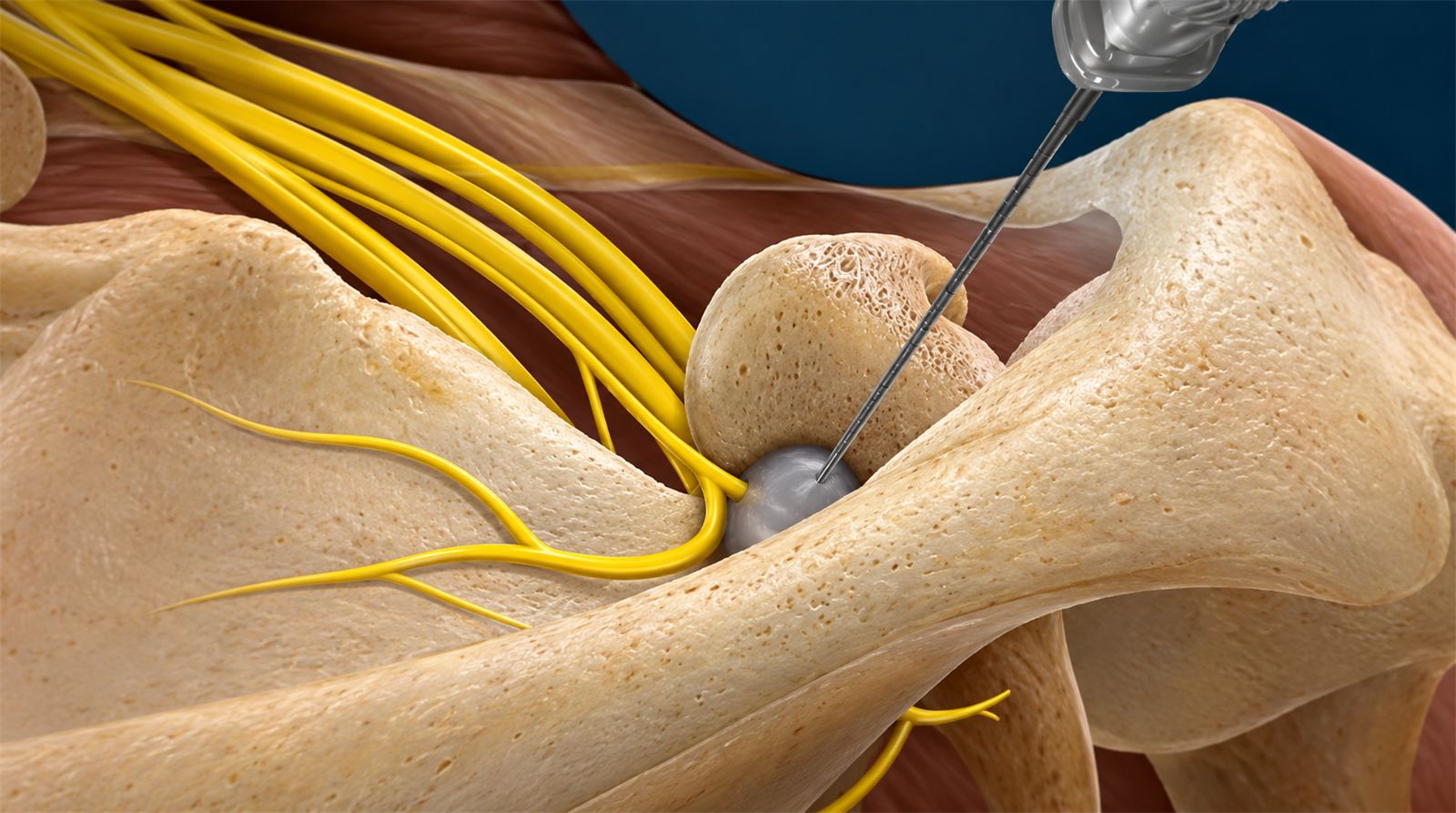 Suprascapular Nerve Block