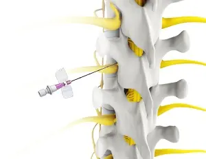 TFESI (Transforaminal Epidural Steroid Injection)