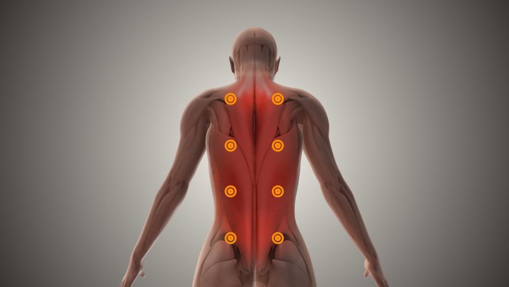 Trigger point Injections